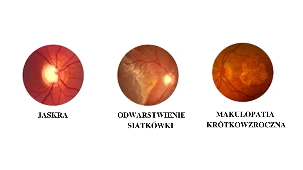 Obrazki przedstawiają zmiany oczne: jaskrę, odwarstwienie siatkówki i makulopatię krótkowzroczną. Pytanie, czy krótkowzroczność można wyleczyć, jest złożone.