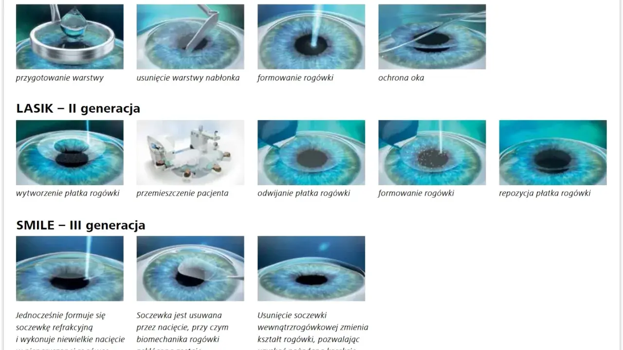 Ilustracje pokazują etapy korekcji wady refrakcji oka metodami PRK, LASIK i SMILE.