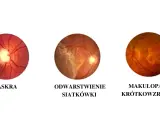 Obrazki przedstawiają zmiany oczne: jaskrę, odwarstwienie siatkówki i makulopatię krótkowzroczną. Pytanie, czy krótkowzroczność można wyleczyć, jest złożone.