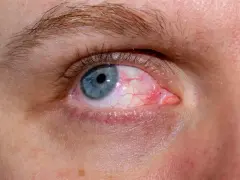 Widoczne pęknięte naczynko w oku, białkówka zaczerwieniona, niebieska tęczówka.