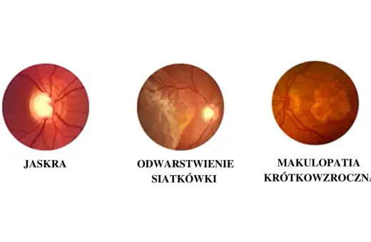Obrazki przedstawiają zmiany oczne: jaskrę, odwarstwienie siatkówki i makulopatię krótkowzroczną. Pytanie, czy krótkowzroczność można wyleczyć, jest złożone.