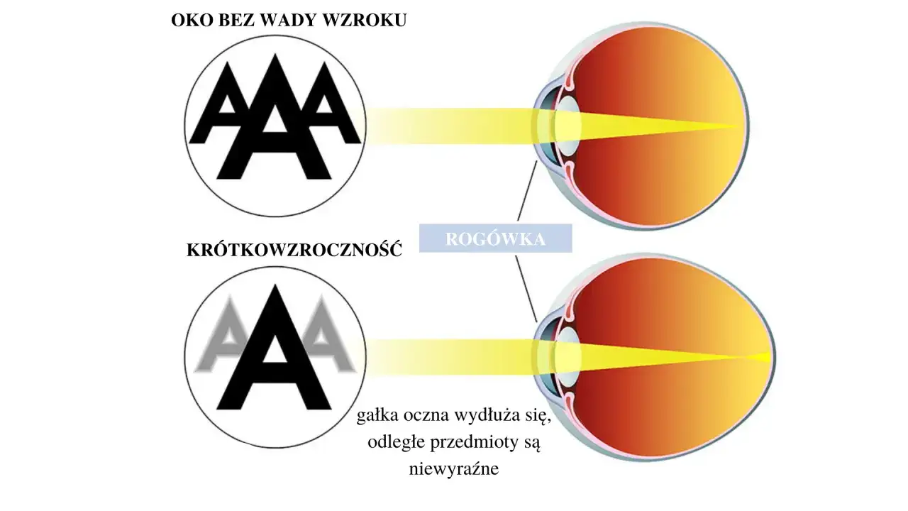 Krótkowzroczność, np. -1.25, powoduje, że oko wydłuża się, a odległe przedmioty są niewyraźne.