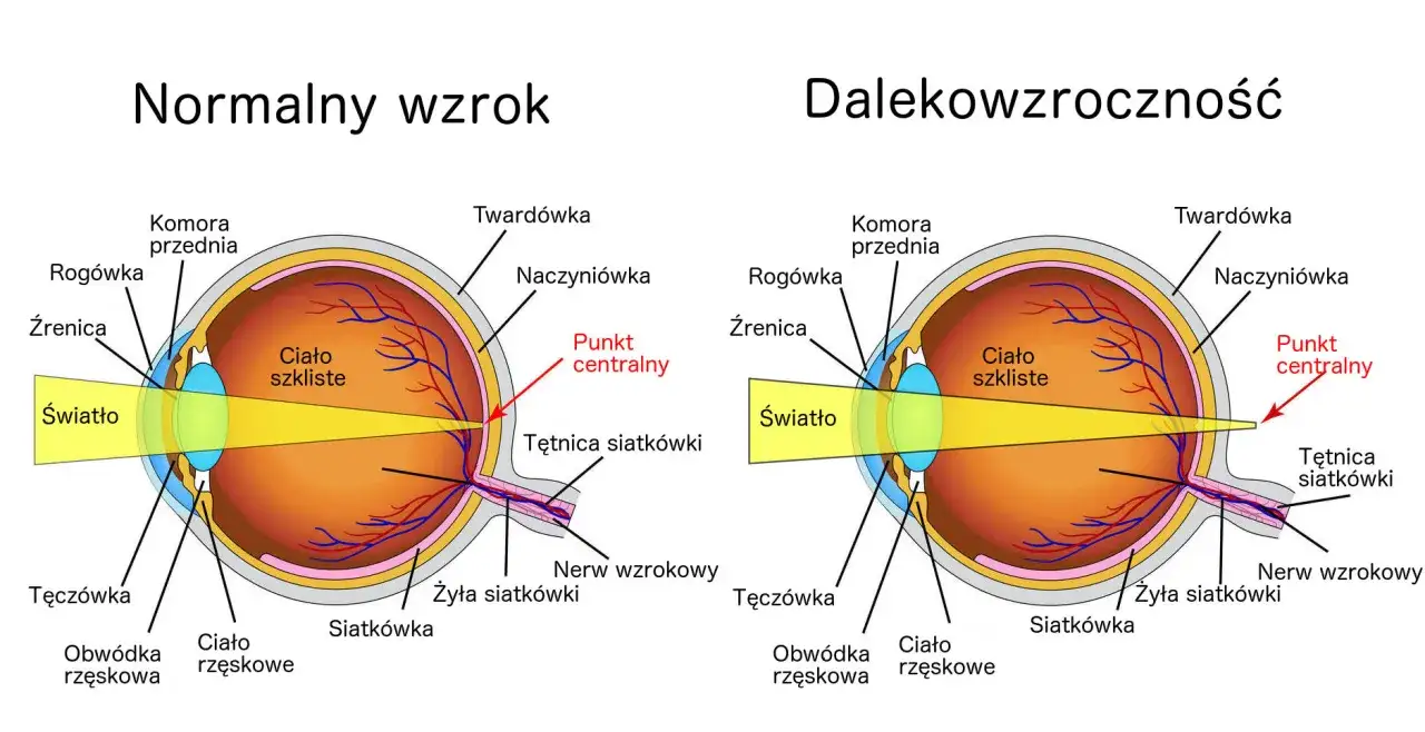 Porównanie oka z normalnym wzrokiem i dalekowzrocznością, ilustrujące h52 zaburzenia refrakcji i akomodacji. Światło skupia się przed siatkówką.